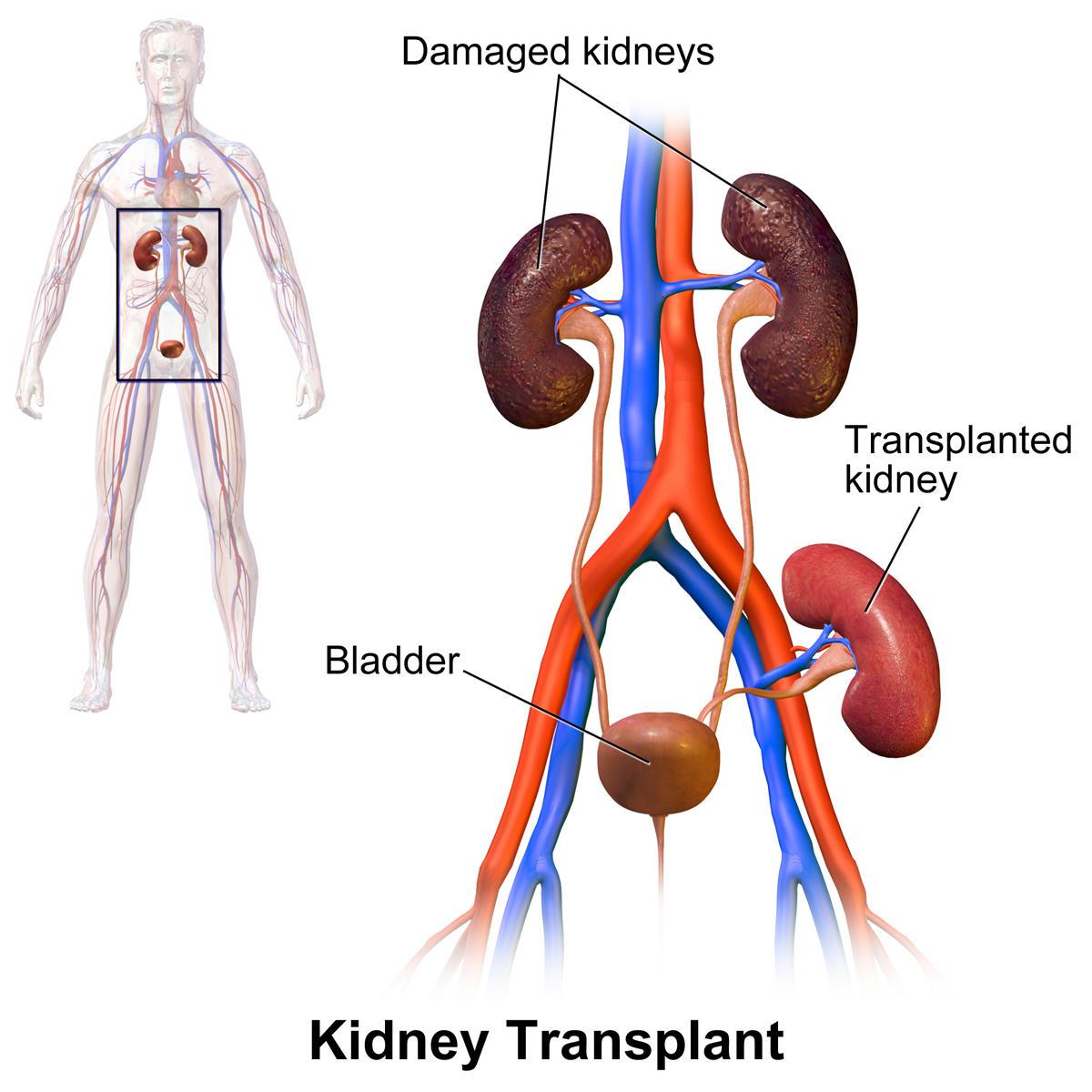 ABOi Kidney Transplant