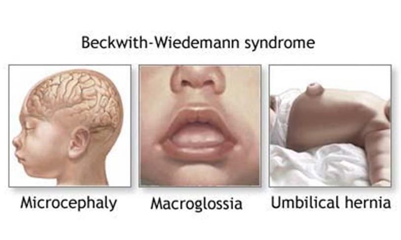 Beckwith_Wiedemann_syndrome