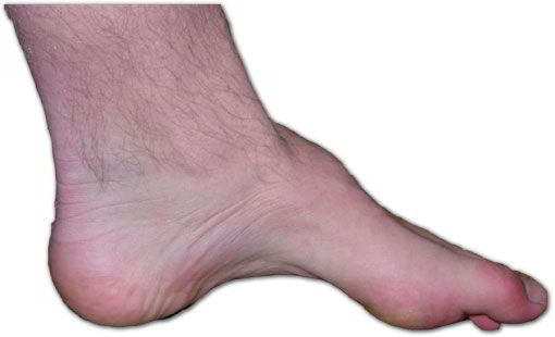 Charcot_marie_tooth_foot