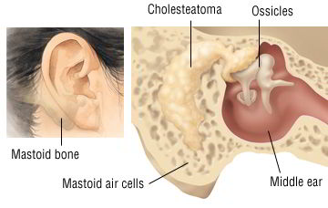 Excision Of Cholesteatoma
