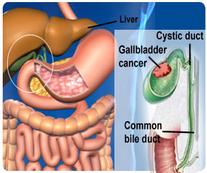 Gall Bladder Cancer