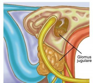 Glomus jugulare tumor