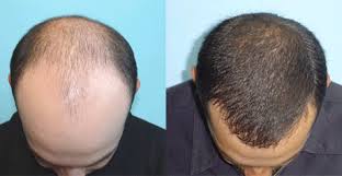 Best Hospitals for HAIR TRANSPLANT in MANGALORE, Cost of HAIR TRANSPLANT in  MANGALORE