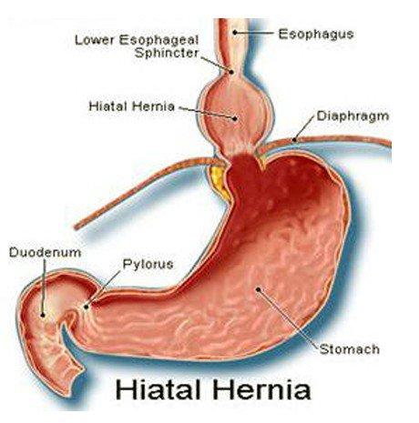 Abdominal Hernia – Gastroenterologist Hyderabad