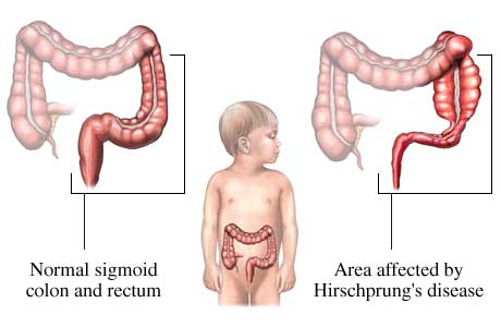 Hirschsprungs disease
