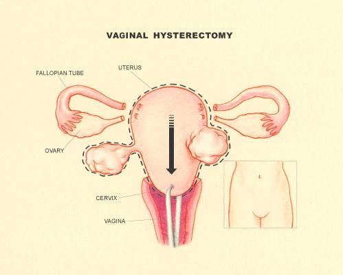 Hysterectomy Vaginal