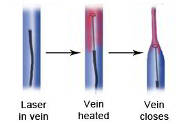 Laser Varicose Vein treatment