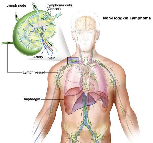 Non Hodgkins Lymphoma Disease