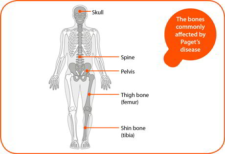 Paget disease of bone