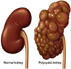 Polycystic Kidney