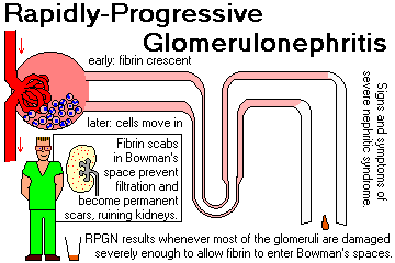 Rapidly progressive glomerulonephritis (RPGN)