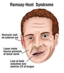 Ramsay_Hunt_syndrome