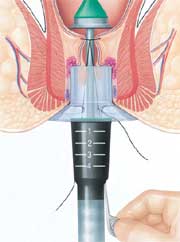 Stapler Haemorrhoidectomy