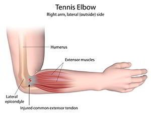 Tennis_Elbow