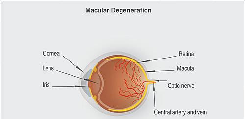 macular_degeneration