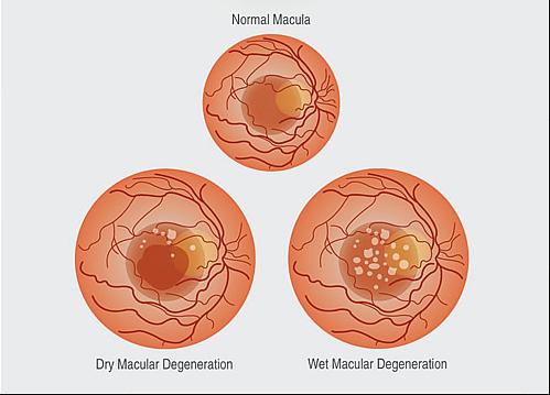 Types of macular_degeneration