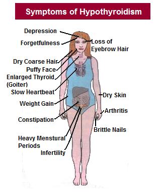 Symptoms of Hypothyroidism